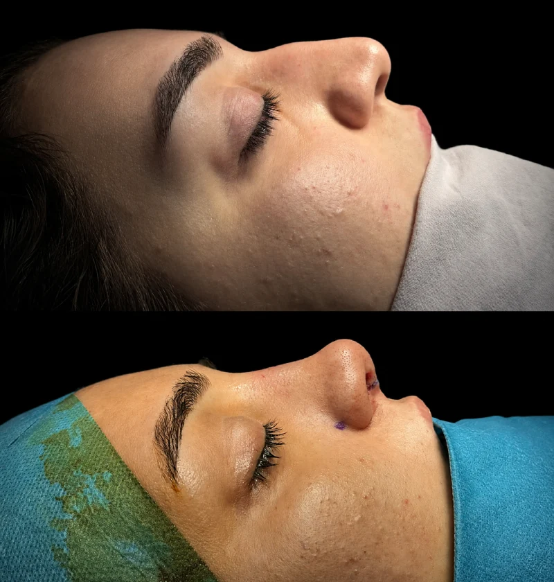 rinoplastika burun əməliyyatı