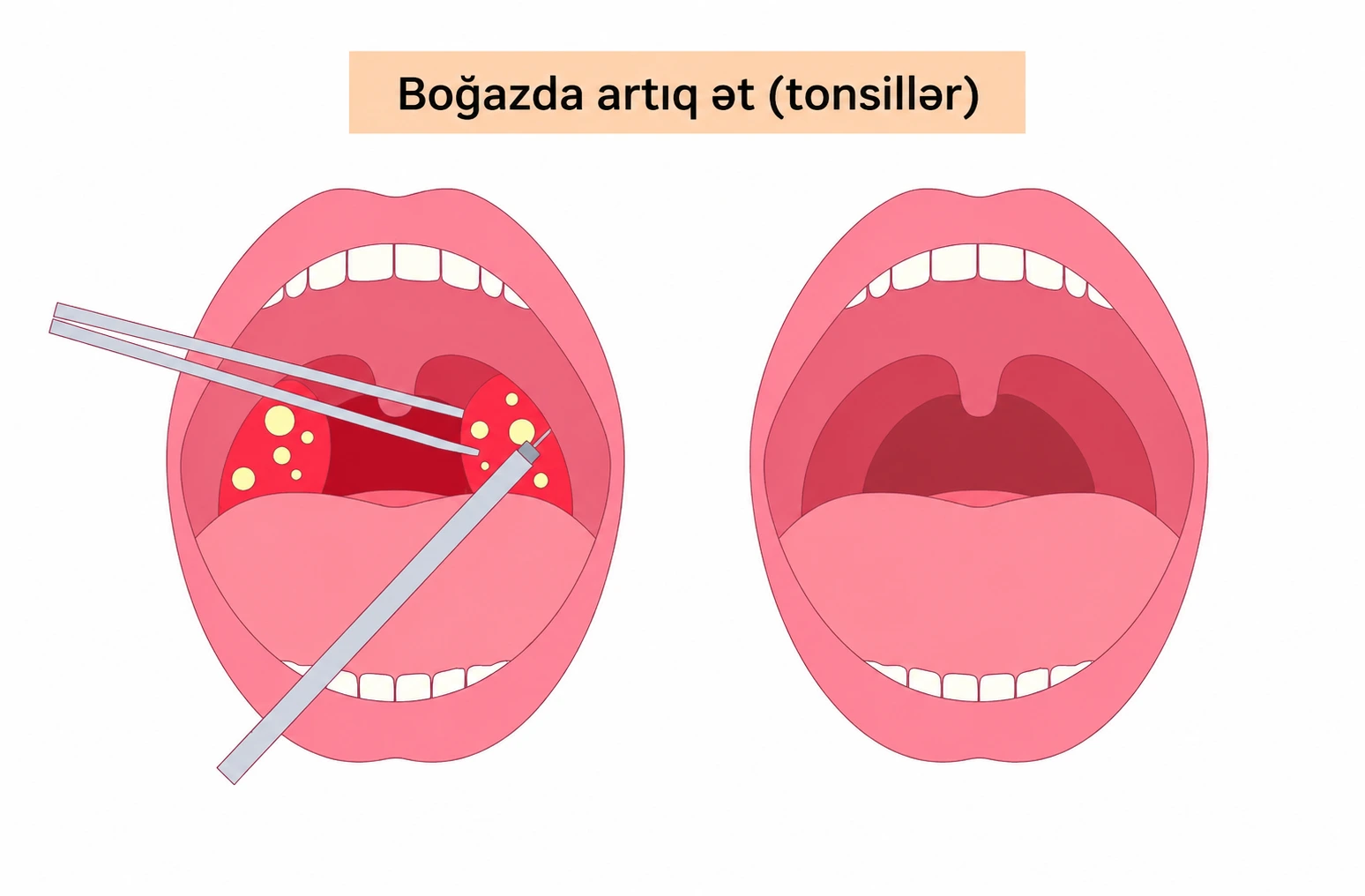 boğazda artıq ət