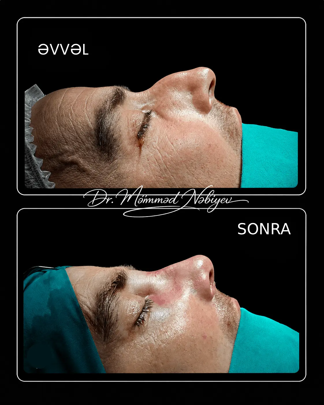 Rinoplastika əməliyyatı nəticəmiz