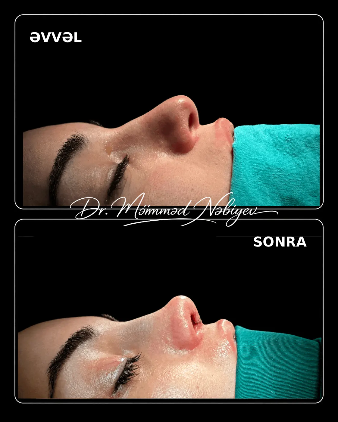rinoplastika evvel sonra