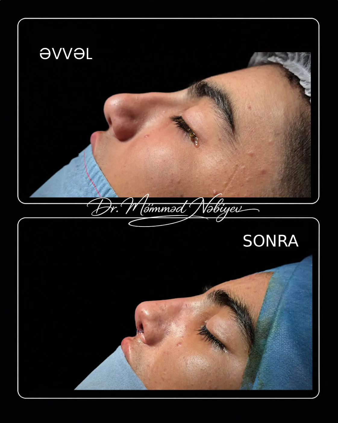 septorinoplastika əməliyyatı